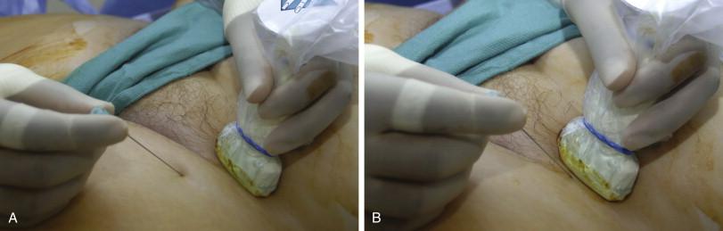 Figure 3-1, Relative positioning of the ultrasound probe and arterial entry needle. A , Retrograde access of the left common femoral artery is achieved by positioning the entry needle several centimeters away from the ultrasound probe. The path of visualization of the ultrasound probe should intersect with the trajectory of the needle and the common femoral artery. B , If the entry needle is placed too close to the ultrasound probe, access requires the needle to be positioned almost 90 degrees to the skin, which is not favorable for passing either subsequent guidewires or sheaths.