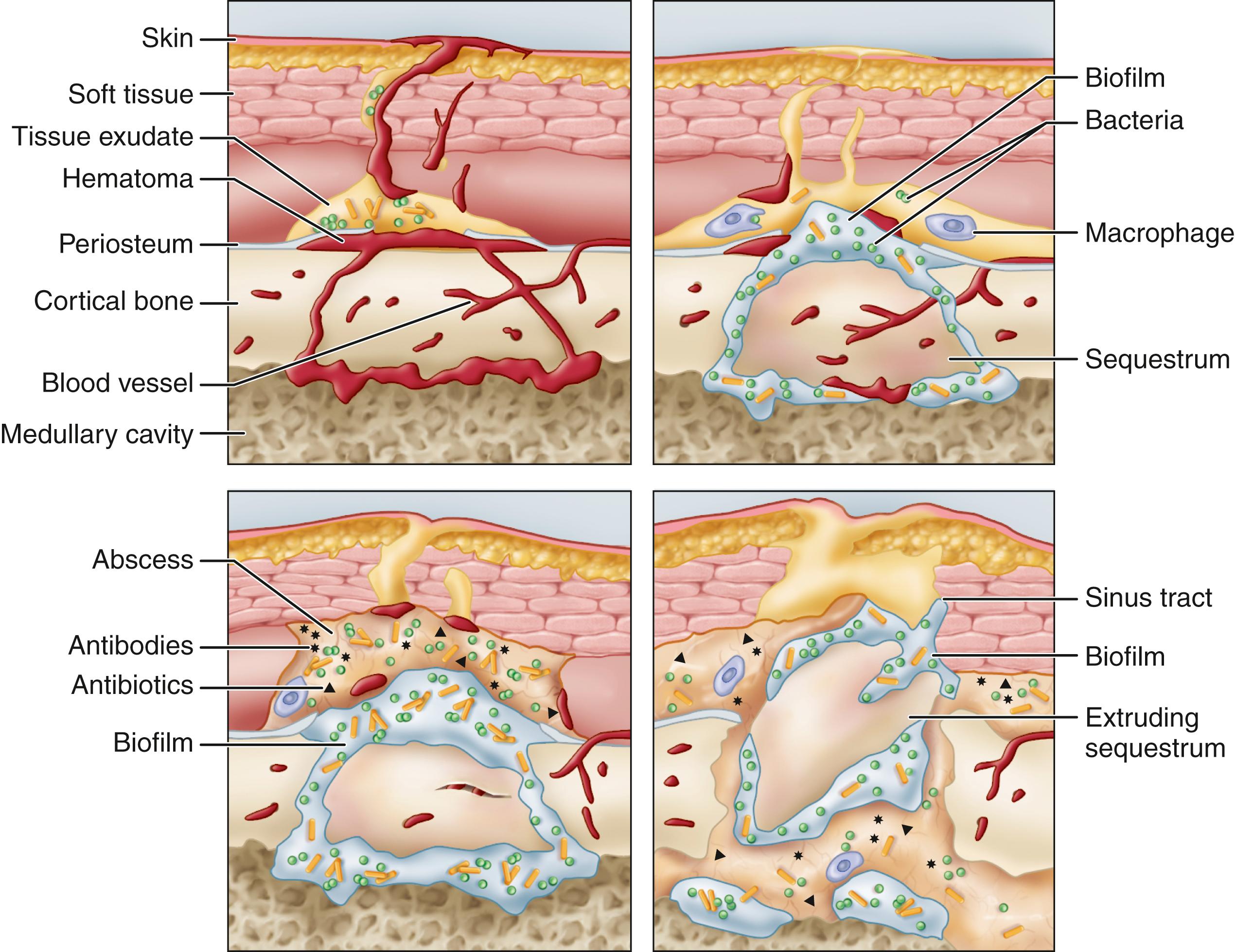 FIGURE 53.9, Sequence of pathogenesis in osteomyelitis. Top left, Initial trauma produces soft-tissue destruction, bone fragmentation, and contamination by bacteria. In closed wounds, contamination may occur by hematogenous seeding. Top right, As infection progresses, bacterial colonization occurs within protective exopolysaccharide biofilm, which is especially abundant on devitalized bone fragment, which acts as passive substratum for colonization. Bottom left, Host defenses are mobilized against infection but cannot penetrate biofilm. Bottom right, Progressive inflammation and abscess formation result in development of sinus track and in some cases ultimate extrusion of sequestrum, which is focus of resistant infection.
