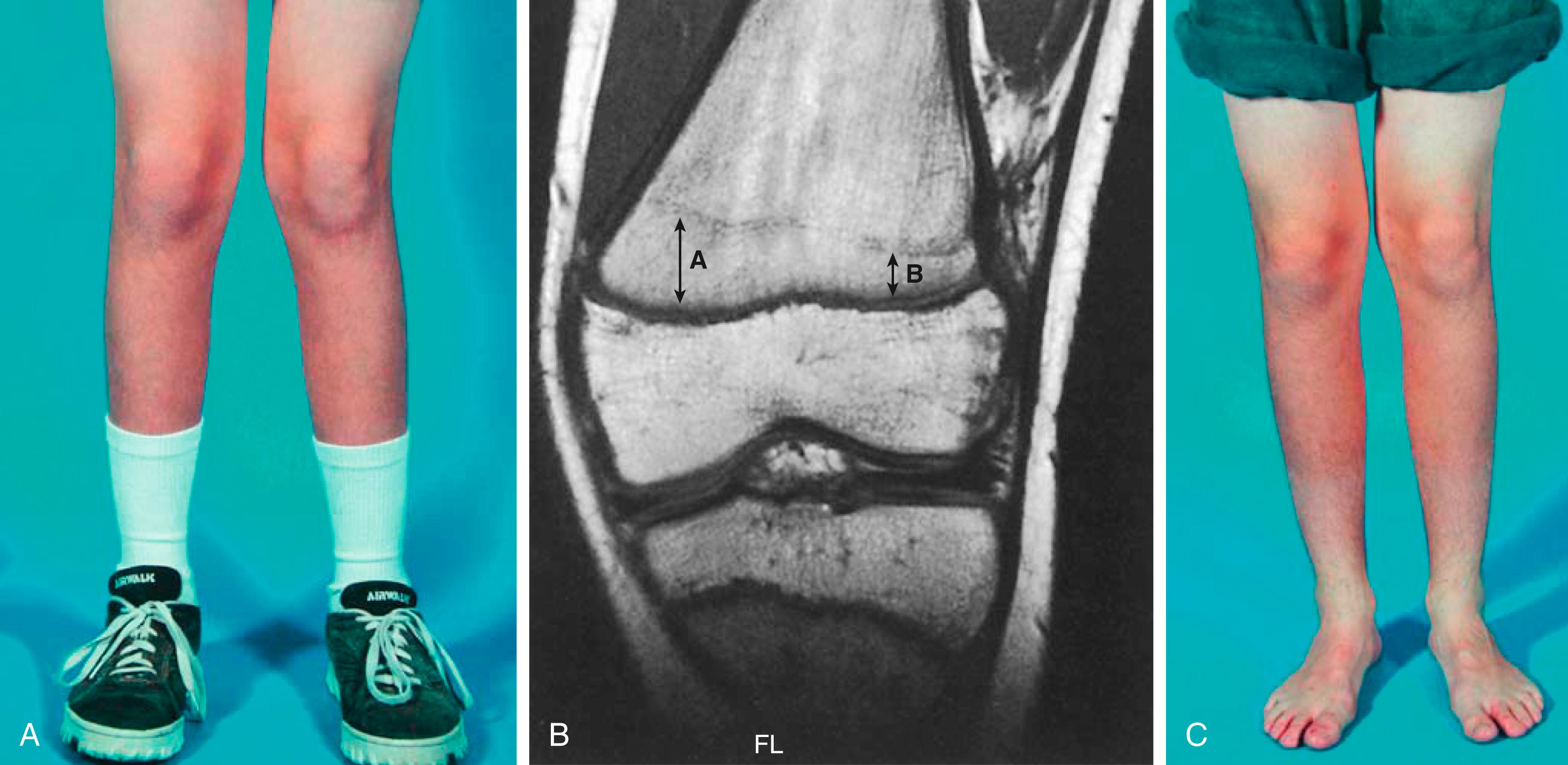 Fig. 27.12, Asymmetric growth following a Salter-Harris type II distal femoral fracture. (A) Valgus deformity 15 months after fracture. (B) Magnetic resonance image demonstrating asymmetric growth of the distal femoral physis. The distance from the physis to the Harris growth arrest line is greater medially (A) than laterally (B). The fact that the growth arrest line has migrated proximally on the lateral aspect reflects a slowing of growth rather than a complete arrest. (C) Clinical appearance 8 months after a medial distal femoral epiphysiodesis was performed. Lateral growth continued until the deformity was corrected. At this point, a lateral hemiepiphysiodesis and a contralateral epiphysiodesis were performed. An 8-plate procedure would have also been appropriate for this case.
