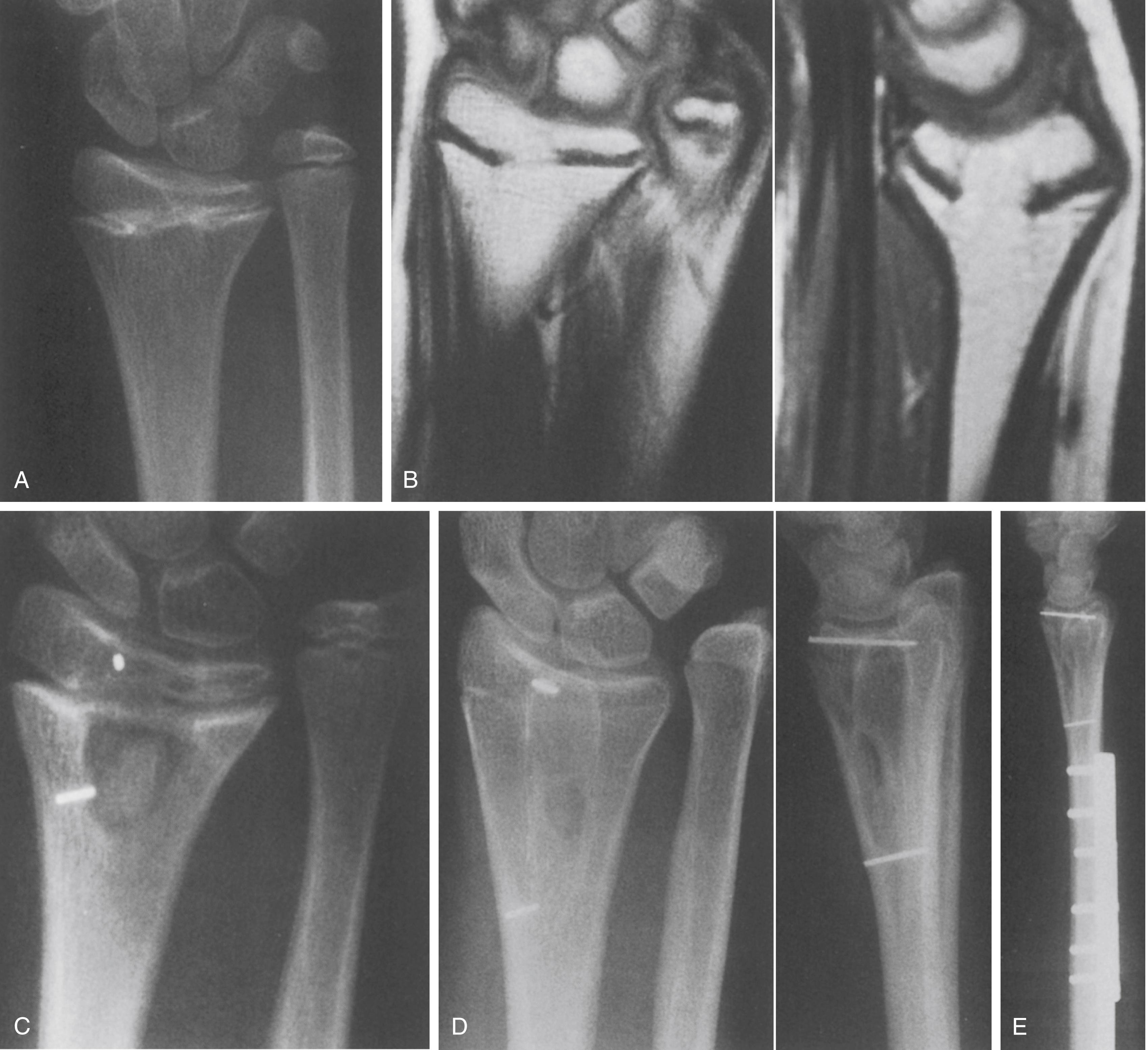 Fig. 27.14, Partial physeal arrest (type b) producing primarily shortening. (A) Anteroposterior (AP) radiograph of the wrist of a 12-year-old girl who had sustained a Salter-Harris type II fracture of the distal radius 6 years earlier. Note the ulnar-positive variance as well as the physeal bar in the center of the distal radius. (B) Coronal and sagittal magnetic resonance images show the extent of the bar. (C) The bar has been resected and metallic markers placed in the epiphysis and metaphysis. (D) AP and lateral radiographs showing resumption of growth, as evidenced by an increased distance between metallic markers. The ulnar-positive variance persists. (E) Lateral radiograph after ulnar shortening to treat symptomatic ulnar-positive variance.