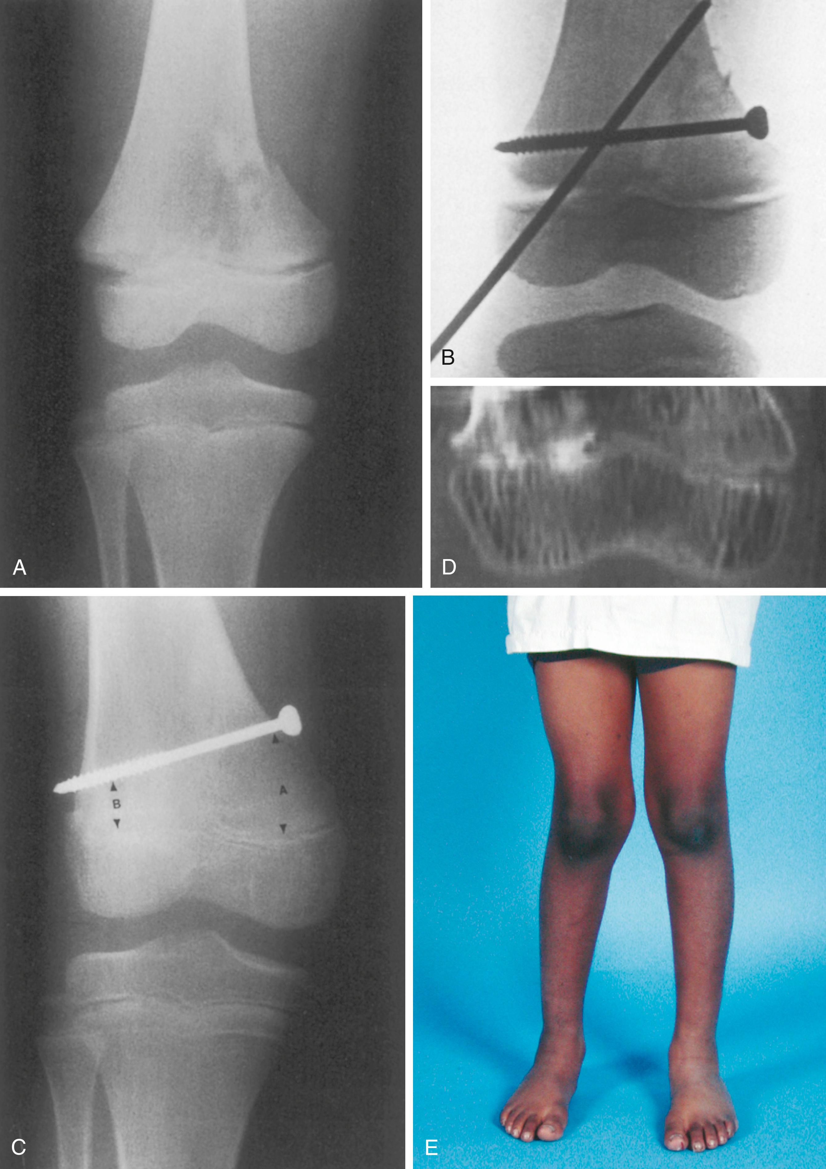 Fig. 27.15, Physeal arrest producing angular deformity. (A) Salter-Harris type II fracture of the distal femur. (B) Immediate postreduction film. (C) Anteroposterior radiograph 9 months after injury. The distance between the physis and the screw medially (A) is substantially greater than it was immediately after surgery. However, the distance laterally (B) is relatively unchanged. Note the radiodense appearance of the physis laterally. (D) Computed tomography scan demonstrating lateral bar formation. (E) The asymmetric growth has produced a valgus clinical appearance.