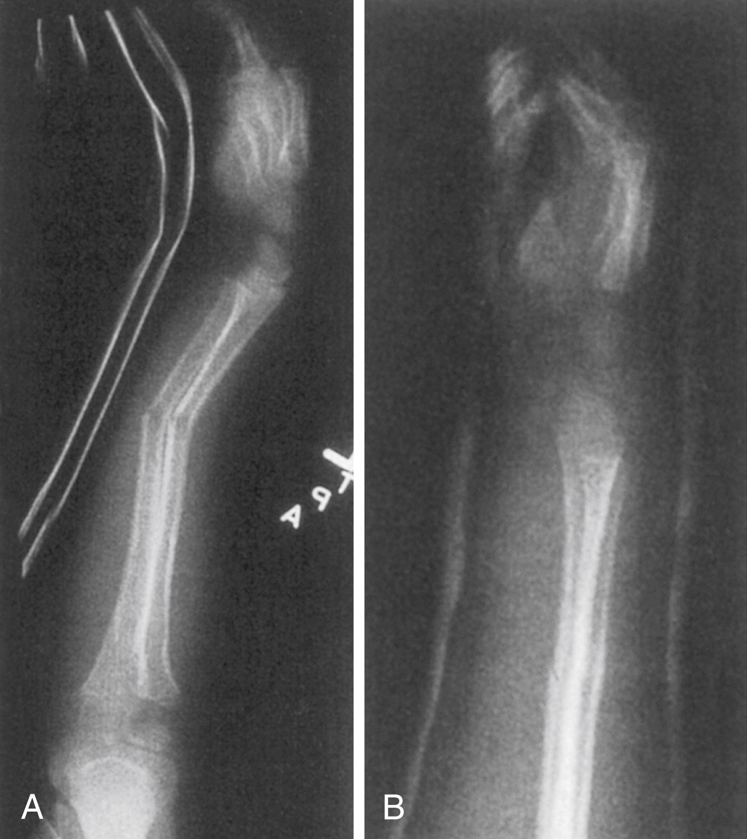 Fig. 27.4, (A) Lateral radiograph of a greenstick forearm fracture of both bones. The dorsal cortex angles without completely fracturing (plastic deformation). (B) Lateral radiograph obtained after reduction.