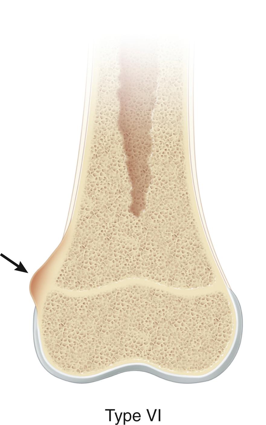 Fig. 27.10, Rang type VI physeal injury. This represents an injury to the perichondral ring (arrow) .