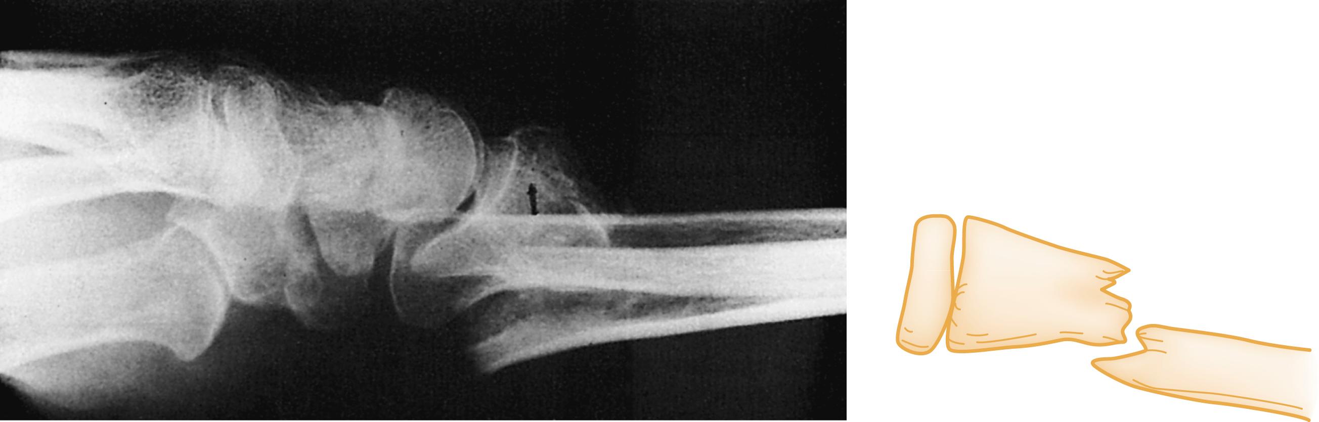Fig. 41.2, Dorsal Displacement of Distal Radius.