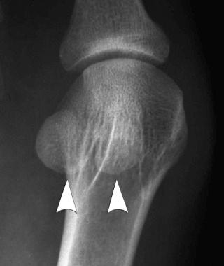 eFIGURE 2–1, Sesamoid bones. The sesamoid bones on the plantar surface of the head of the first metatarsal (arrows) are located in the tendons of the adductor hallucis and the lateral head of the flexor hallucis brevis and the abductor hallucis and medial head of the flexor hallucis brevis muscles. Other sesamoid bones include the patella and the pisiform bone of the wrist.