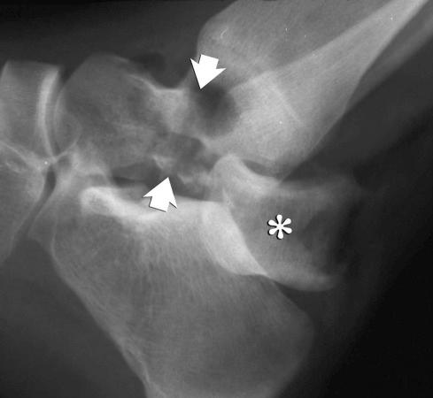 eFIGURE 2–10, Fracture-dislocation. The lateral radiograph of the foot and ankle shows a complete fracture through the neck of the talus (arrows) with posterior dislocation of the separate proximal fragment (asterisk) .