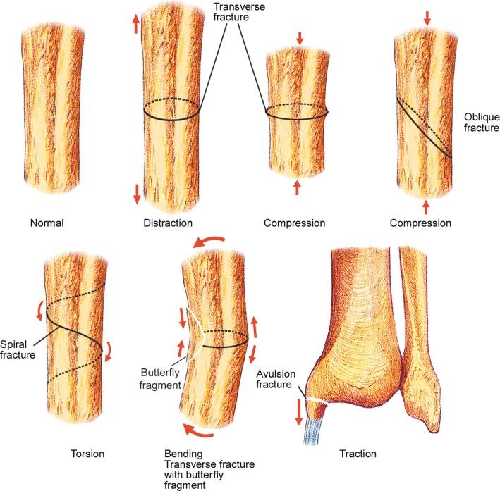 FIGURE 2–2, Mechanism of injury/fracture types.