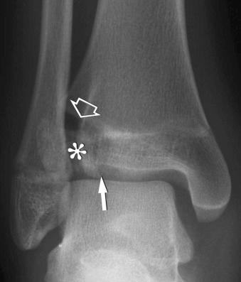 eFIGURE 2–11, Biplanar fracture of Tillaux. The mortise view of the right ankle shows a vertical fracture through the lateral aspect of the distal right tibial epiphysis (arrow) , disruption of the lateral aspect of the physis (open arrow) , and lateral distraction of the separate fragment (asterisk) by the intact distal tibiofibular ligaments. Compare with eFigure 2-12 .