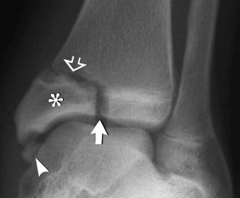 eFIGURE 2–12, Salter-Harris type III physeal injury. The fracture to the distal tibial epiphysis (arrow) and separation of the medial aspect of the physis (open arrow) result in medial displacement of the medial epiphyseal fragment (asterisk) . The medial malleolar styloid process is an ununited secondary ossification center (arrowhead) .