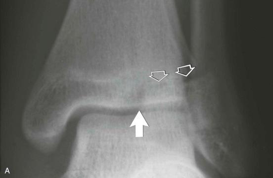 eFIGURE 2–13, Triplanar fracture of the distal left tibia. The frontal projection ( A ) shows a sagittal plane fracture through the epiphysis (arrow) and disruption of the lateral aspect of the physis in the axial plane (open arrows) . The lateral radiograph ( B ) shows the coronally oriented fracture of the posterior aspect of the tibia (arrowheads) . In this instance, the epiphyseal, physeal, and metaphyseal components constitute a single fragment. Hence, this is an example of a two-part triplanar fracture.