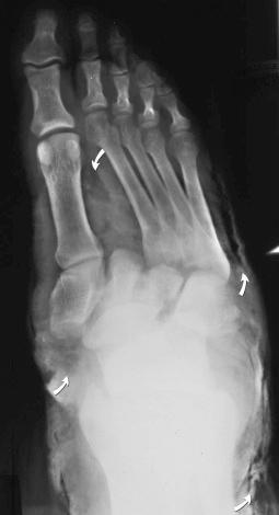 eFIGURE 2–15, Open fracture of the right foot caused by a crush injury. Subcutaneous emphysema is extensive (curved arrows) .