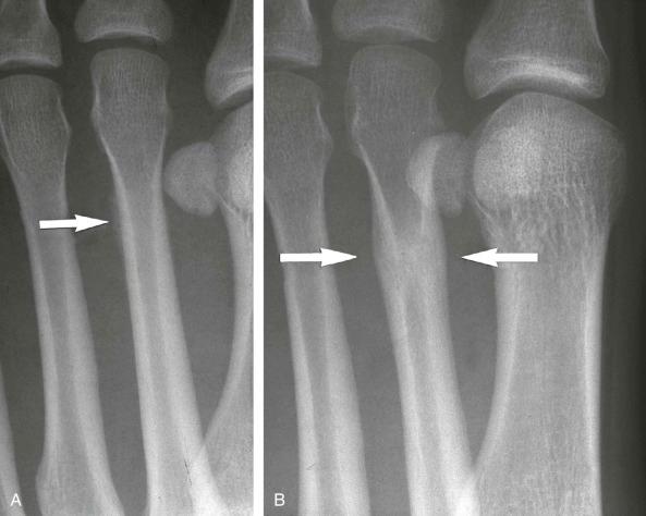 FIGURE 2–3, Stress fracture. Oblique radiograph ( A ) of the left foot shows very minimal callus formation (arrow) at the distal diaphysis of the second metatarsal. A similar projection of the left foot taken 3 months later ( B ) clearly demonstrates circumferential callus formation (arrows) of the healed stress fracture.