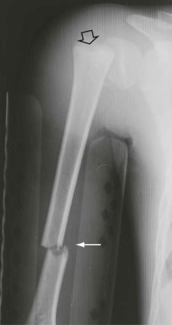 eFIGURE 2–16, Transverse fracture at the junction of the middle and distal thirds of the humerus (arrow) . The open arrow indicates a concomitant Salter-Harris I physeal injury with displacement of the metaphysis relative to the humeral head epiphysis.