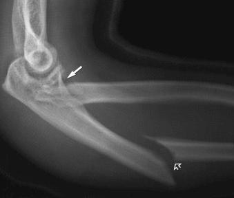 eFIGURE 2–17, Displaced, angulated, distracted fracture of the proximal ulna (open arrow) . The ulnar fracture is a component of the Bado type IV Monteggia injury. The straight arrow indicates the radial head-neck component.