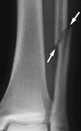 eFIGURE 2–18, Oblique fracture (arrows) in the distal third of the left fibula.