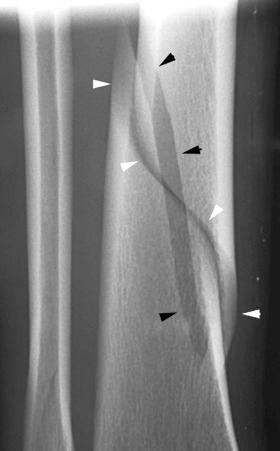 eFIGURE 2–19, Spiral fracture. The fracture line, with its sharply pointed edges, makes a complete rotation around the shaft of a long bone, the tibia in this instance (white arrowheads) . The vertical component (black arrowheads) , acting as a hinge, causes the fragments on the back side of the fracture to separate.
