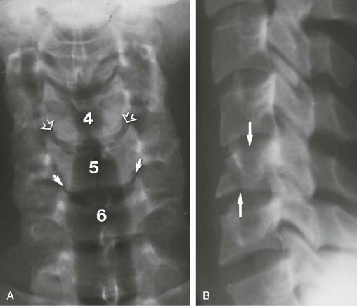 eFIGURE 2–20, Axial loading (impacted) fracture of C5. Impaction, or compression, of the body of C5 resulted in bilateral separation of the C5 body fragments as evidenced by the widening of the C4–5 (open arrows) and narrowing (arrows) of the C5–6 Luschka joints ( A ). The lateral radiograph ( B ) shows a burst (bursting) fracture of C5 (arrows) .