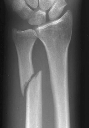 eFIGURE 2–21, Displaced fracture. The frontal radiograph of the wrist shows the distal ulnar fragment laterally displaced with respect to the proximal fragment.