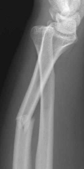 eFIGURE 2–22, Angulated fracture. The lateral radiograph of a Galeazzi fracture shows volar angulation of the distal radial fragment with respect to its proximal fragment.