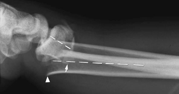 eFIGURE 2–23, Displaced, angulated fracture. The lateral radiograph of the forearm and wrist shows the distal radial fragment to be both angulated ( broken lines indicate long axis of each radial fragment) and displaced ( arrowhead indicates the volar cortex of the proximal fragment and the arrow the volar cortex of the distal fragment).