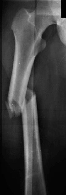 eFIGURE 2–24, Bayonet, or overriding, fracture as indicated by the position of the distal femoral fragment with respect to its proximal fragment.