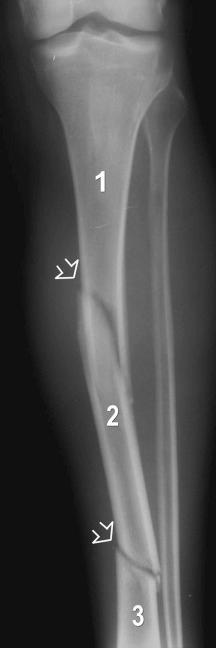 eFIGURE 2–25, Segmental fracture. The anteroposterior radiograph of the leg shows two fracture sites in the tibia (open arrows) resulting in three distinct fracture fragments ( 1 to 3 ).