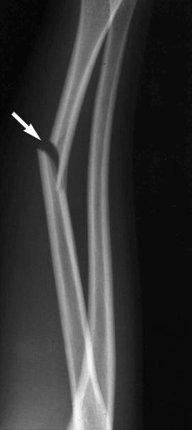 eFIGURE 2–26, Greenstick (incomplete) fracture of the radius (arrow) . Note bowing of the ulna.