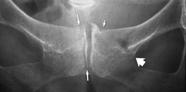 eFIGURE 2–27, Insufficiency fractures of the pubic symphysis (arrows) .