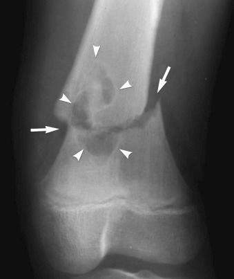 eFIGURE 2–28, Pathologic fracture (arrows) through a benign cortical defect (arrowheads) of the distal femur.