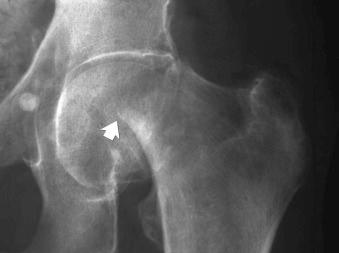 eFIGURE 2–29, Impacted, subcapital fracture (arrow) of the left femur.