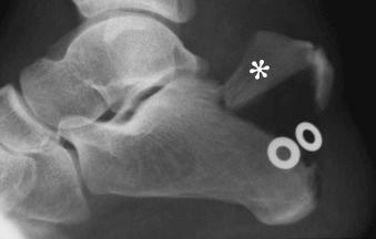 eFIGURE 2–30, “Beak” fracture of the os calcis. The separate fragment (asterisk) is avulsed by abrupt, forceful contraction of the Achilles tendon. Metallic rings indicate sites of concomitant skin laceration.