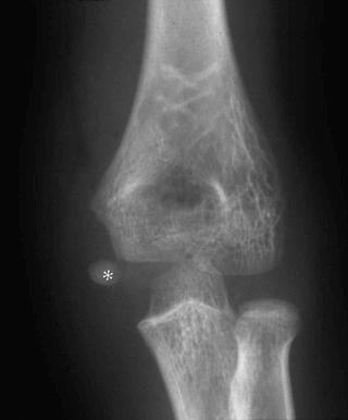 eFIGURE 2–31, Little Leaguer's elbow. Avulsion and displacement of the medial epicondylar apophysis (asterisk) is due to repeated contractions of the flexor muscles of the forearm.