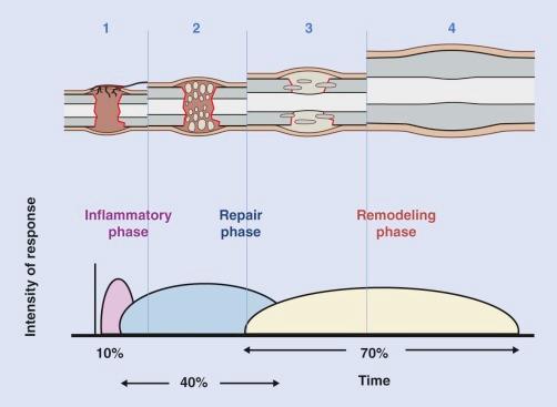 FIGURE 2–4, Secondary bone healing in unstable fractures: The passage through different tissue stages of increasing stiffness and strength leads to a biomechanical environment permitting bone formation. Inflammatory phase: The defect is initially filled with hematoma and there is intense inflammation (1) . Repair phase: This is quickly replaced by granulation tissue (2) . Remodeling phase: Over the weeks a fibrocartilaginous callus is formed (3) . Mineralization leads to formation of a hard callus, becoming fusiform and slowly disappearing as haversian remodeling progresses (4) .