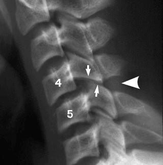 eFIGURE 2–5, Disruption of the posterior ligament complex. Anterior subluxation of C4 on C5 is characterized by widening of the interspinous space (arrowhead) , subluxation of the C4–C5 interfacetal joints (arrows) , and anterior rotation of the C4 vertebra relative to C5.