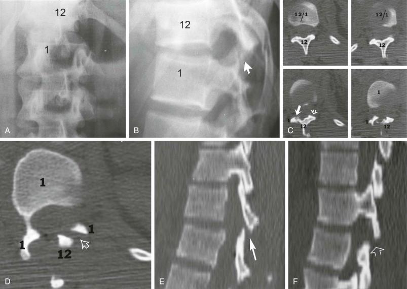 FIGURE 2–1, A to F , Soft tissue chance injury of T12. A , Anteroposterior radiograph of the thoracolumbar spine shows rotation of T12 to the patient's left side. B , Lateral radiograph shows anterior rotation of T12 with subluxation of the T12–L1 apophyseal joints (arrow) . C , Axial CT images of T12–L1 show subluxation of the right T12–L1 apophyseal joint (arrow) and the “naked” left T12 facet (open arrow) . D , Axial CT of the T12–L1 area shows the complete left T12–L1 interfacetal dislocation (open arrow) . E , Sagittal reformatted CT image shows T12–L1 right interfacetal joint subluxation (arrow) . F , Sagittal reformatted CT image shows left interfacetal joint dislocation (open arrow) .