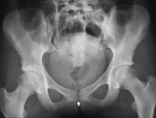 eFIGURE 2–6, Pelvic ring disruption with separation of the pubic symphysis (arrow) and each sacroiliac joint (open arrows) without associated fracture.