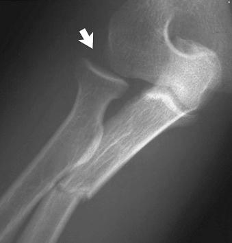 eFIGURE 2–7, Subluxation of the radial head. The frontal radiograph of the right elbow shows lateral subluxation (arrow) of the radial head with respect to the capitellum as one component of a Bado type III Monteggia fracture-dislocation of the elbow.