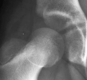 eFIGURE 2–8, Posterior dislocation of the right femoral head with respect to the acetabulum.