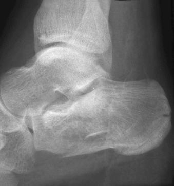 eFIGURE 2–9, Comminuted fracture of the os calcis.