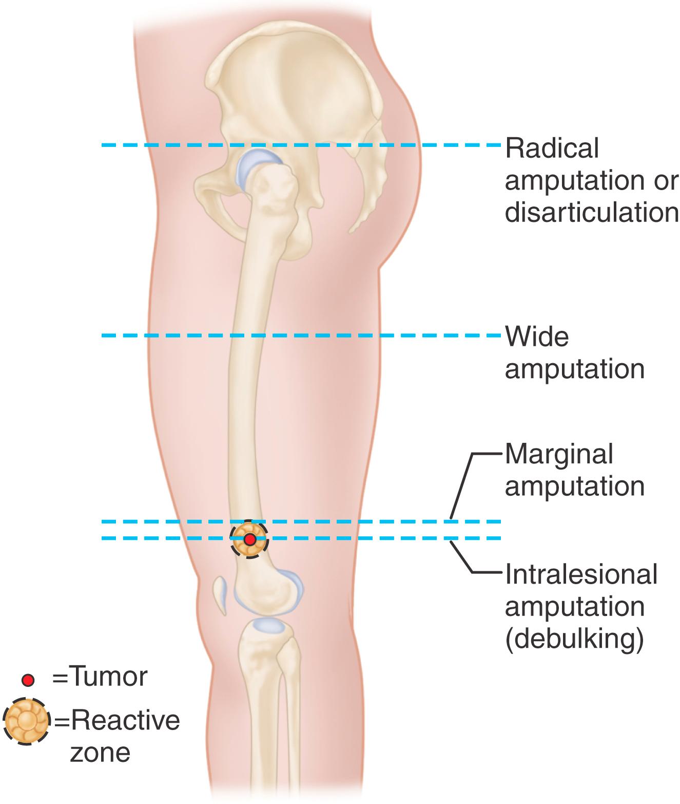 FIGURE 24.12, Enneking classification of amputations.