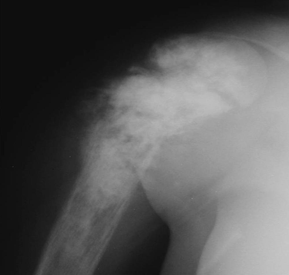 FIGURE 24.6, Stage IIB malignant lesion: osteosarcoma of the proximal humerus.