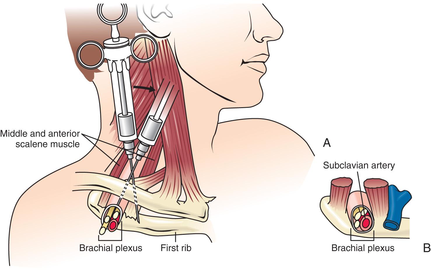 FIG 13.1, A, Supraclavicular block. The interscalene groove is identified at the clavicular level, typically 1.5 to 2.0 cm posterior to the midpoint of the clavicle. Palpation of the subclavian artery at this site confirms the landmark. A 22-gauge, 4-cm needle is directed in a caudad, slightly medial and posterior direction until either a paresthesia or motor response is elicited or the first rib is encountered. If the first rib is encountered without elicitation of a paresthesia, the needle can be systematically walked anteriorly and posteriorly along the rib until the plexus or the subclavian artery is located. Location of the artery provides a useful landmark; the needle can be withdrawn and reinserted in a more posterolateral direction that usually results in a paresthesia or motor response. On localization of the brachial plexus, a total volume of 20 to 30 mL of solution is injected. B, The three trunks are compactly arranged at the level of the first rib.