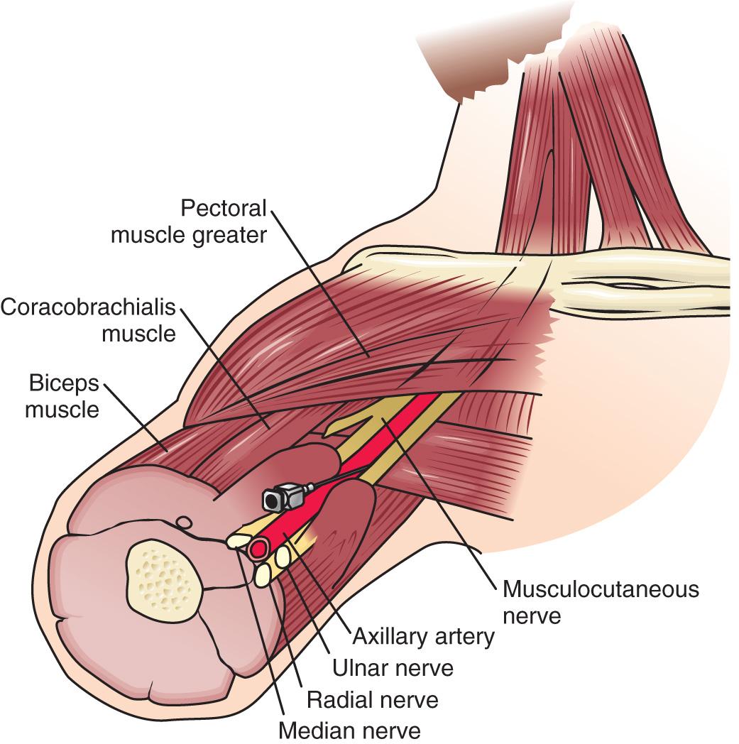 FIG 13.2, Axillary block. The arm is abducted at right angles to the body, and the axillary artery is identified. Proximal needle placement and maintenance of distal digital pressure facilitate proximal spread of the local anesthetic. Several methods of identifying the brachial plexus (transarterial injection, elicitation of paresthesia or motor response) have been described, all with reportedly good results. Overall, multiple injections (identifying more than one peripheral nerve) may shorten the onset and increase the reliability of blockade.