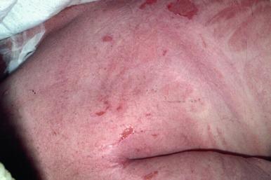 Figure 14.4, Toxic epidermal necrolysis – note erythema and full thickness skin separation. Patient was in intensive care unit.