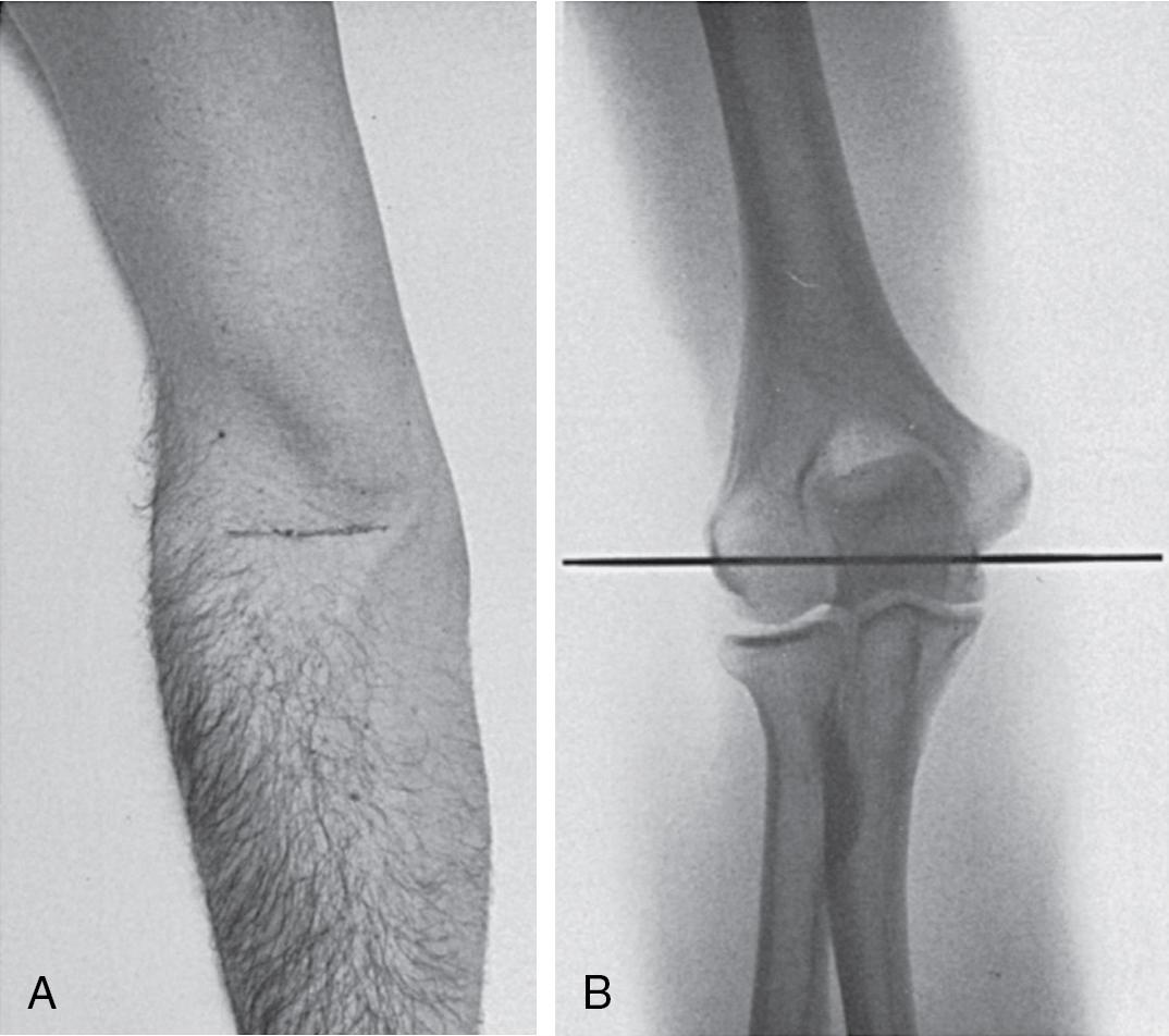 Fig. 42.1, A line placed over the flexion crease (A) is actually situated approximately 1 cm proximal to the elbow joint line (B).