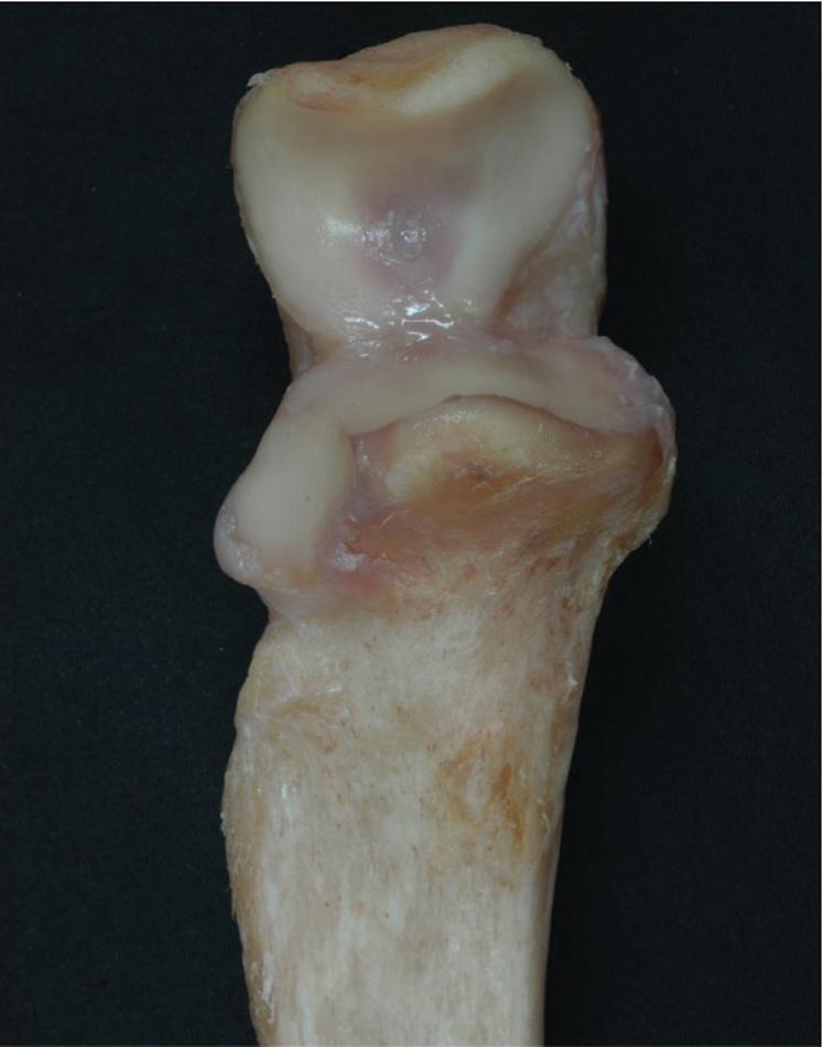 Fig. 42.3, The proximal ulna, depicting the distribution of articular cartilage with a transverse portion of nonarticular cartilage separating the anterior coronoid and posterior olecranon.
