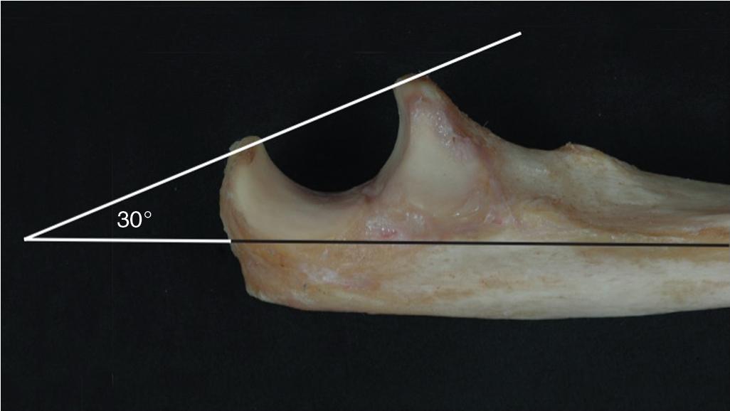 Fig. 42.4, The greater sigmoid notch opens posteriorly with respect to the long axis of the ulna, matching the 30-degree anterior rotation of the distal humerus.