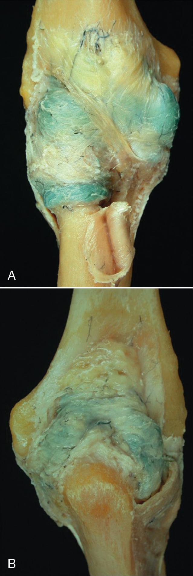 Fig. 42.5, Dye distending the elbow joint capsule, demonstrating the complex network of fibrous support (A). Distribution of the synovial membrane from the posterior aspect is shown in (B), demonstrating the presence of a synovial recess under the annular ligament.