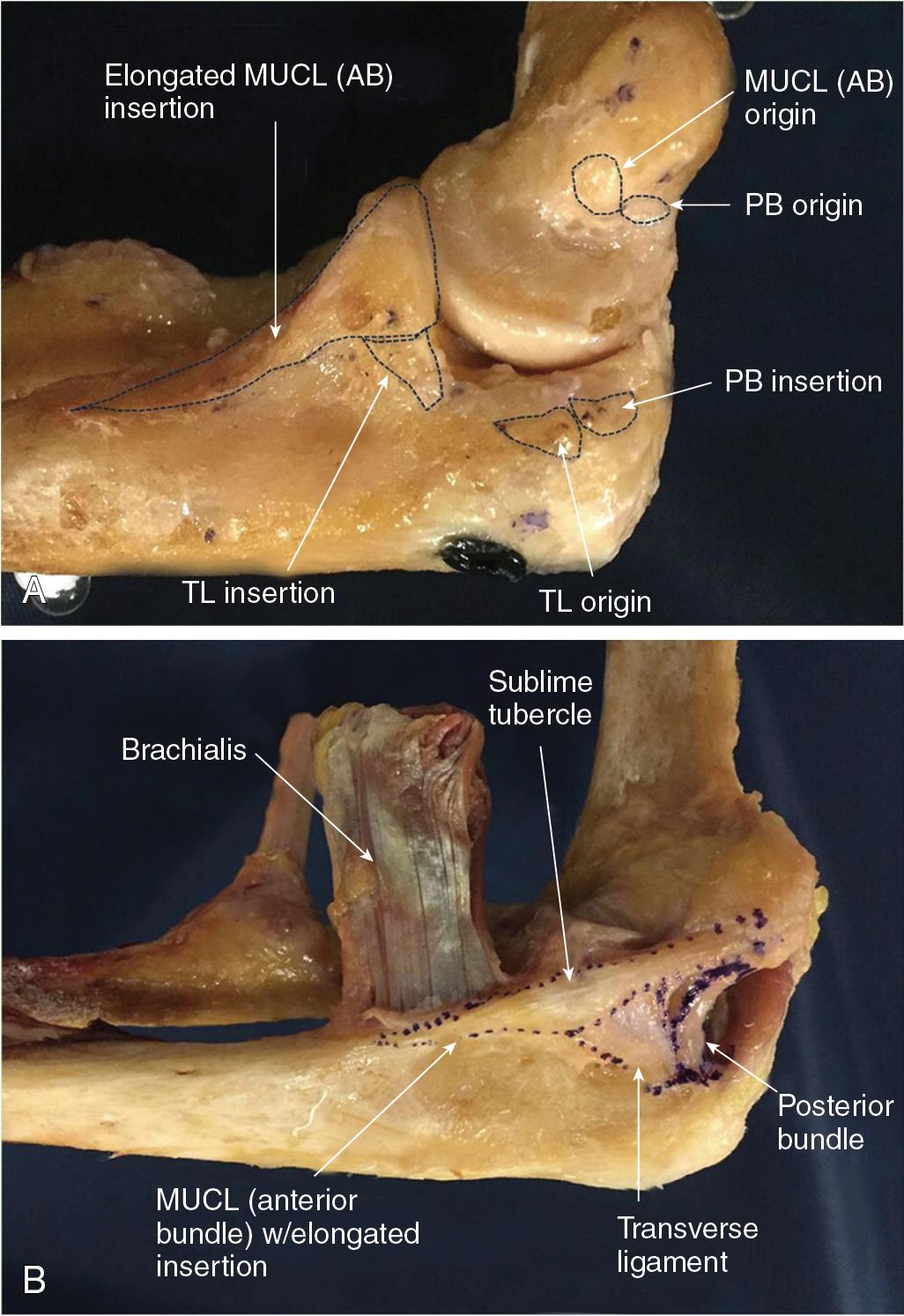 Fig. 42.6, Cadaveric specimen showing origins and insertions of all components of medial ulnar collateral ligament complex (A). Ligaments are intact on medial elbow (B). AB, Anterior bundle; MUCL , medial ulnar collateral ligament; PB , posterior bundle; TL , transverse ligament.