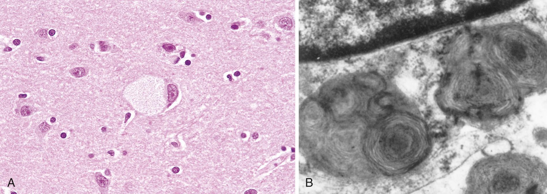 Figure 5.11, Ganglion cells in Tay-Sachs disease. (A) Under the light microscope, a large neuron has obvious lipid vacuolation. (B) A portion of a neuron under the electron microscope shows prominent lysosomes with whorled configurations. Part of the nucleus is shown above.